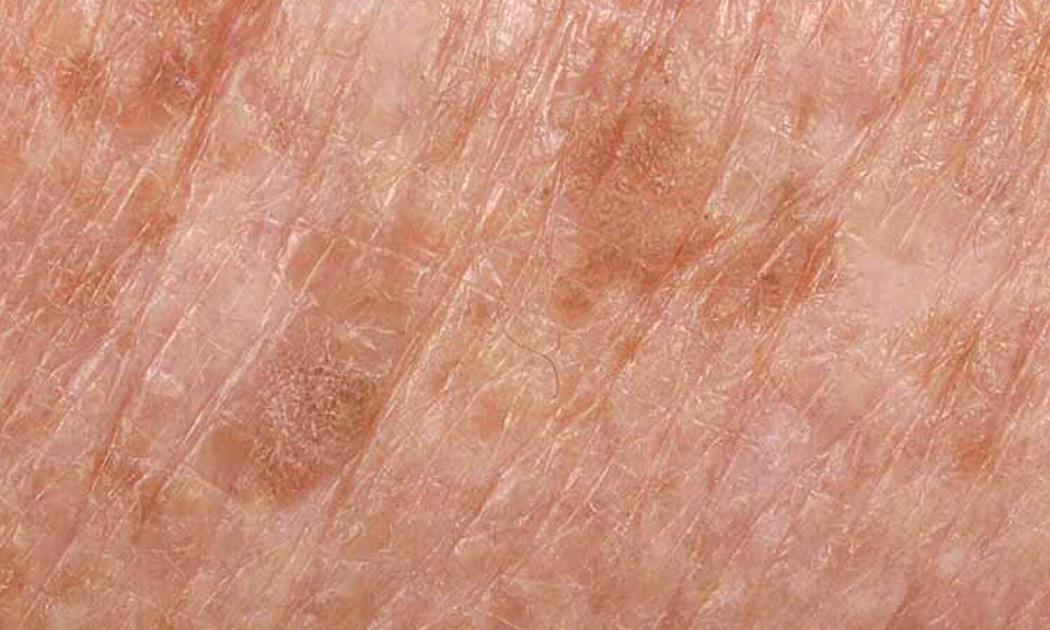 Huidtherapeut Groenlo Huidprobleem Huidveroudering