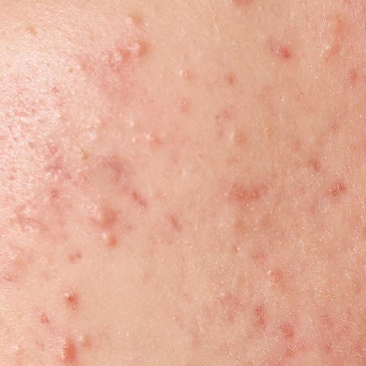 Huidtherapeut Groenlo Huidprobleem Acne