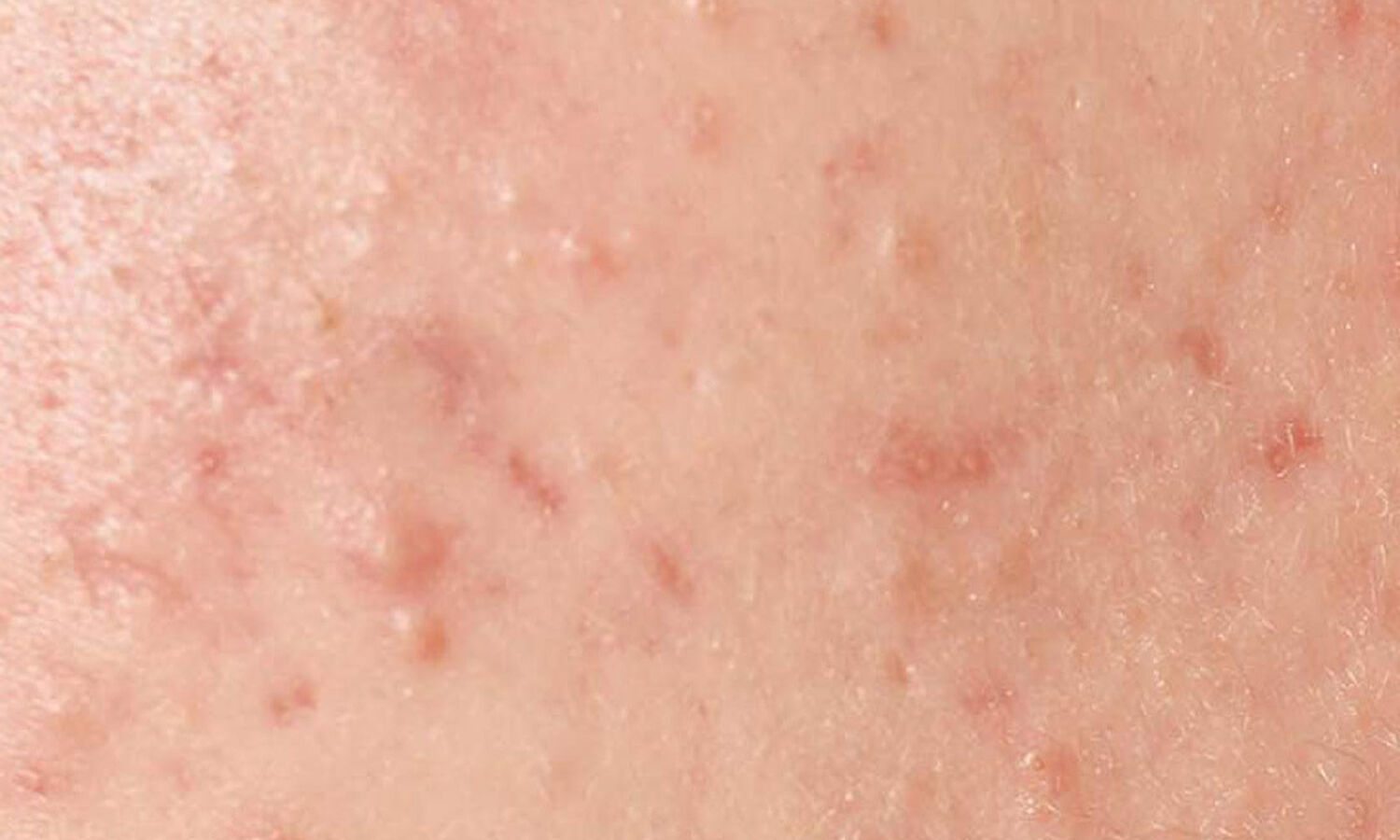 Huidtherapeut Groenlo Huidprobleem Acne