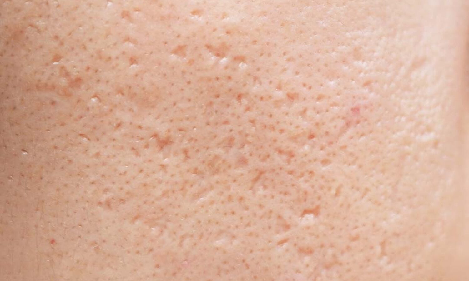 Huidtherapeut Groenlo Huidprobleem Acnelittekens