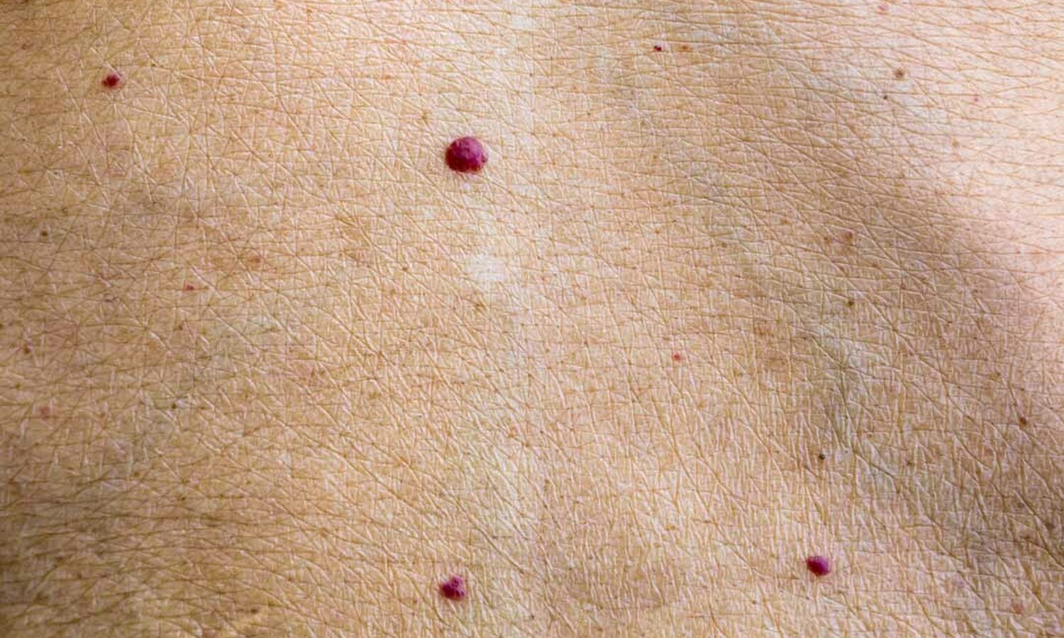 Huidtherapeut Groenlo Huidprobleem Cherry spot Angioma senilis