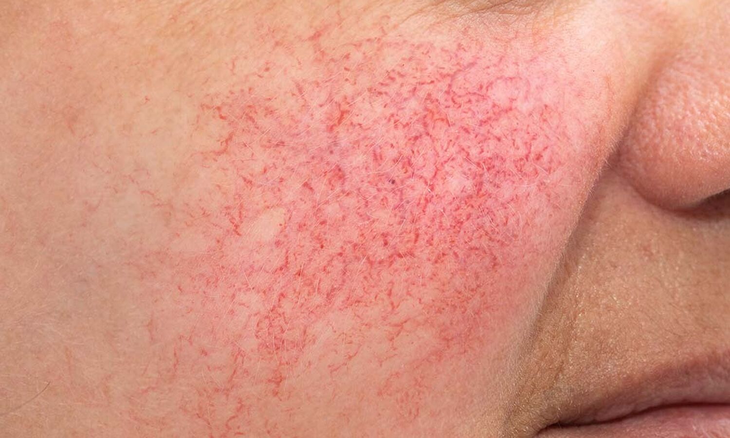 Huidtherapeut Groenlo Huidprobleem Couperose