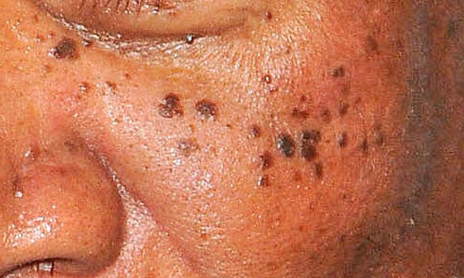 Huidtherapeut Groenlo Huidprobleem Dermatosis papulosa nigra