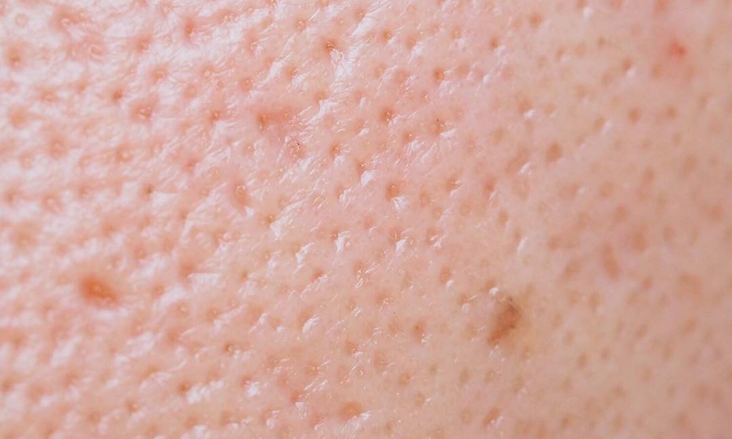 Huidtherapeut Groenlo Huidprobleem grove poriën