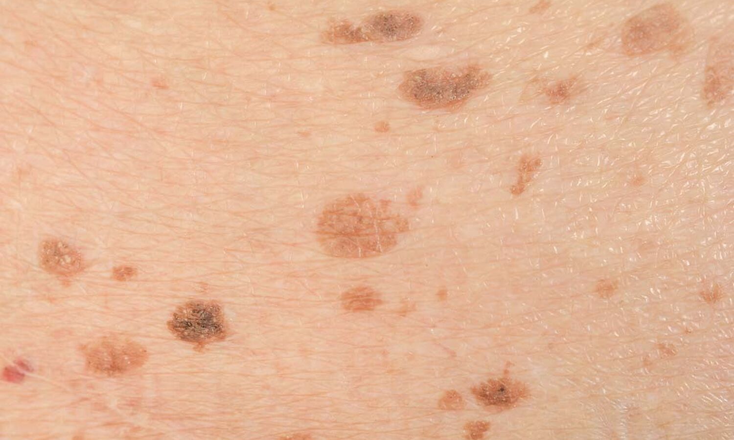 Huidtherapeut Groenlo Huidprobleem Ouderdomsvlekken Lentigo solaris