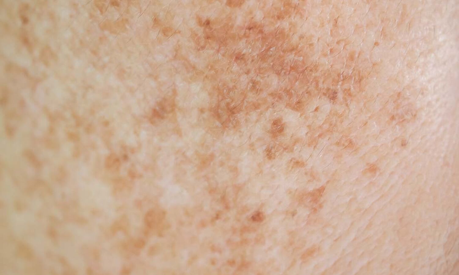 Huidtherapeut Groenlo Huidprobleem Zwangerschapsmasker Melasma