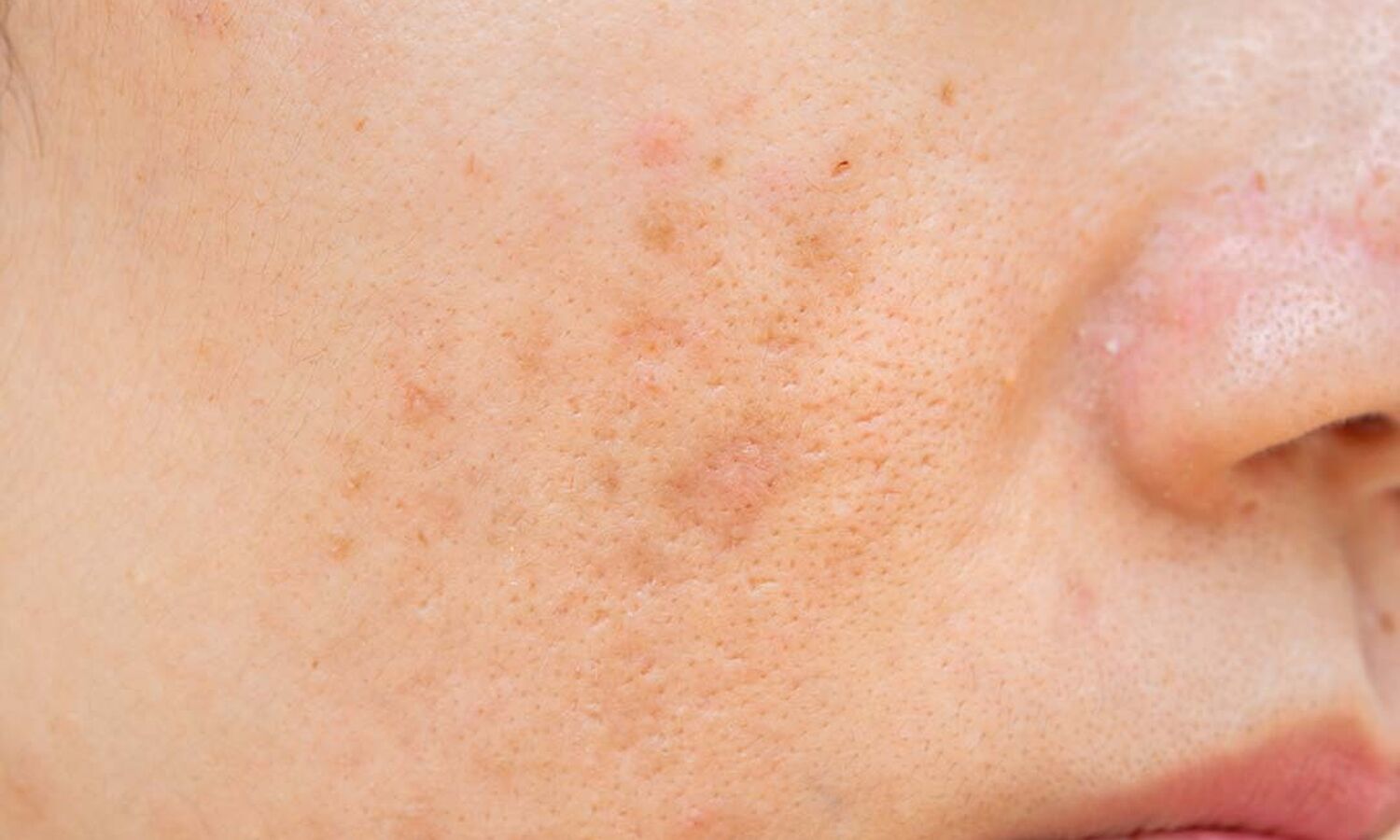 Huidtherapeut Groenlo Huidprobleem PIH