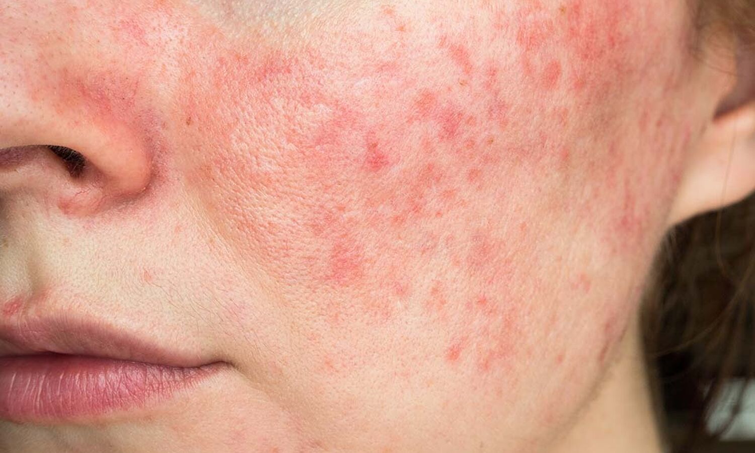 Huidtherapeut Groenlo Huidprobleem Rosacea