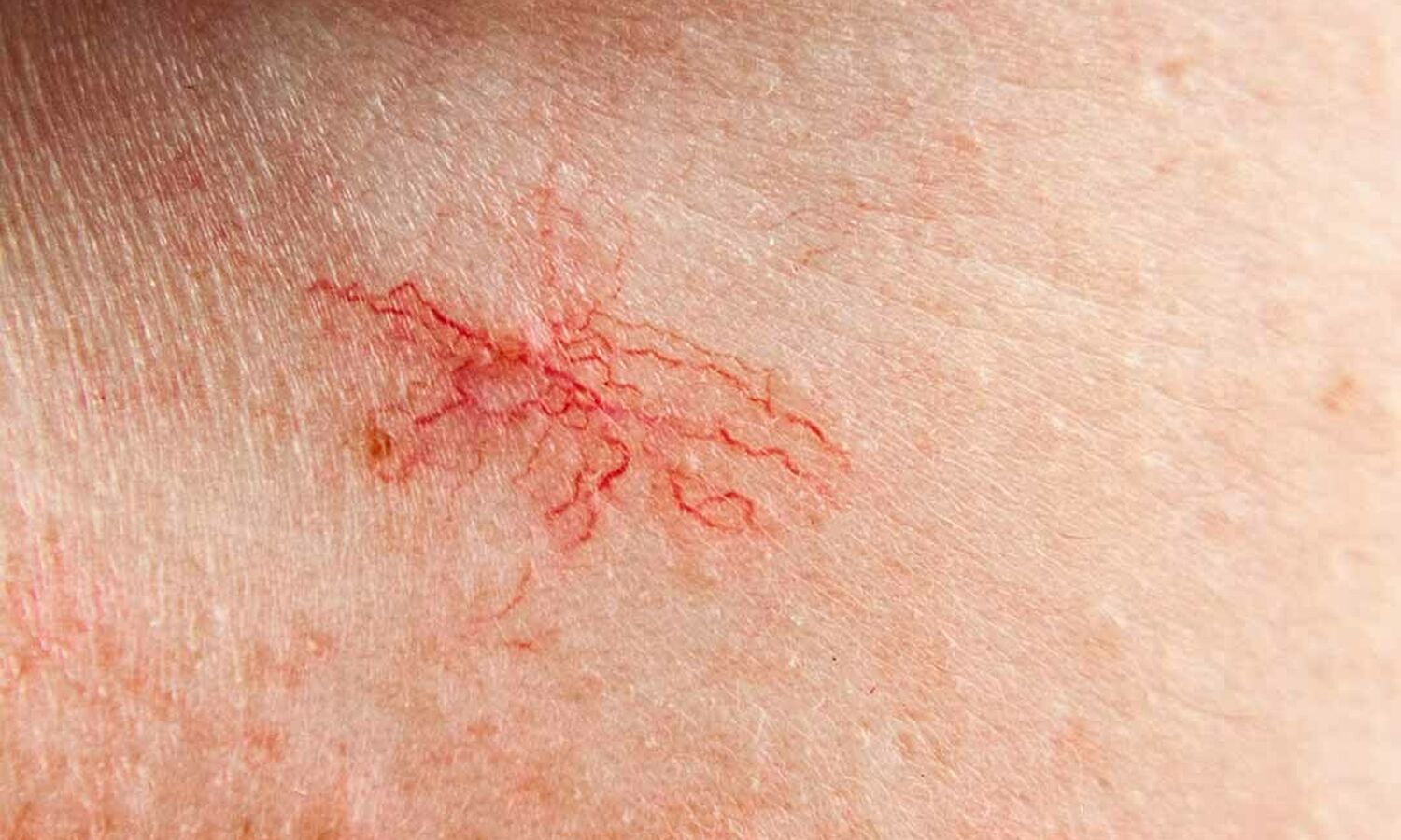 Huidtherapeut Groenlo Huidprobleem Spider naevus