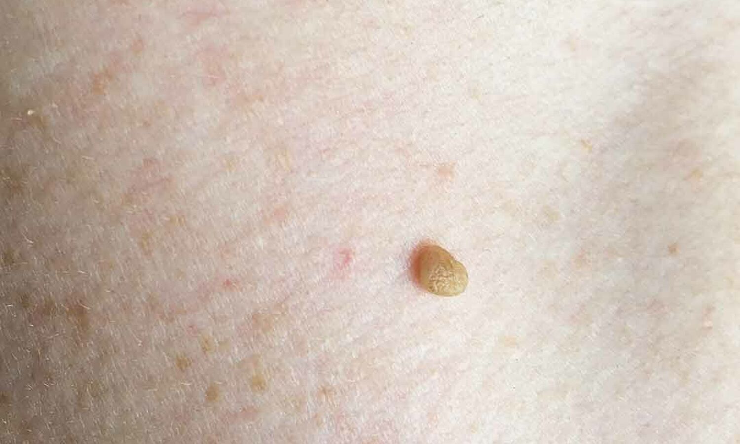 Huidtherapeut Groenlo Huidprobleem Steelwratjes