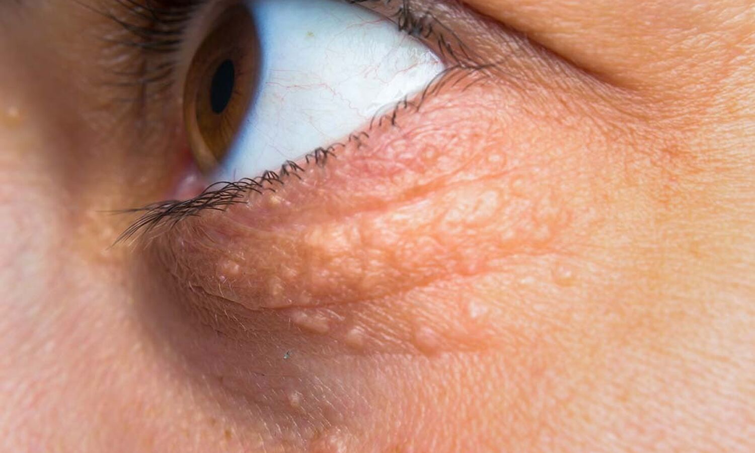 Huidtherapeut Groenlo Huidprobleem Syringomen