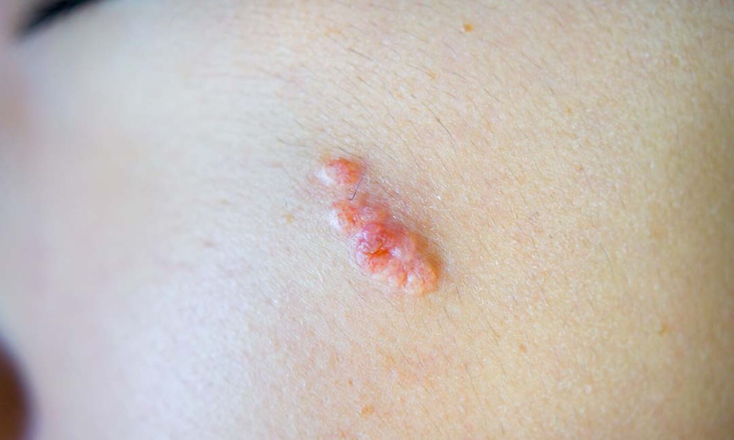 Huidtherapeut Groenlo Huidprobleem Talgklierhyperplasie