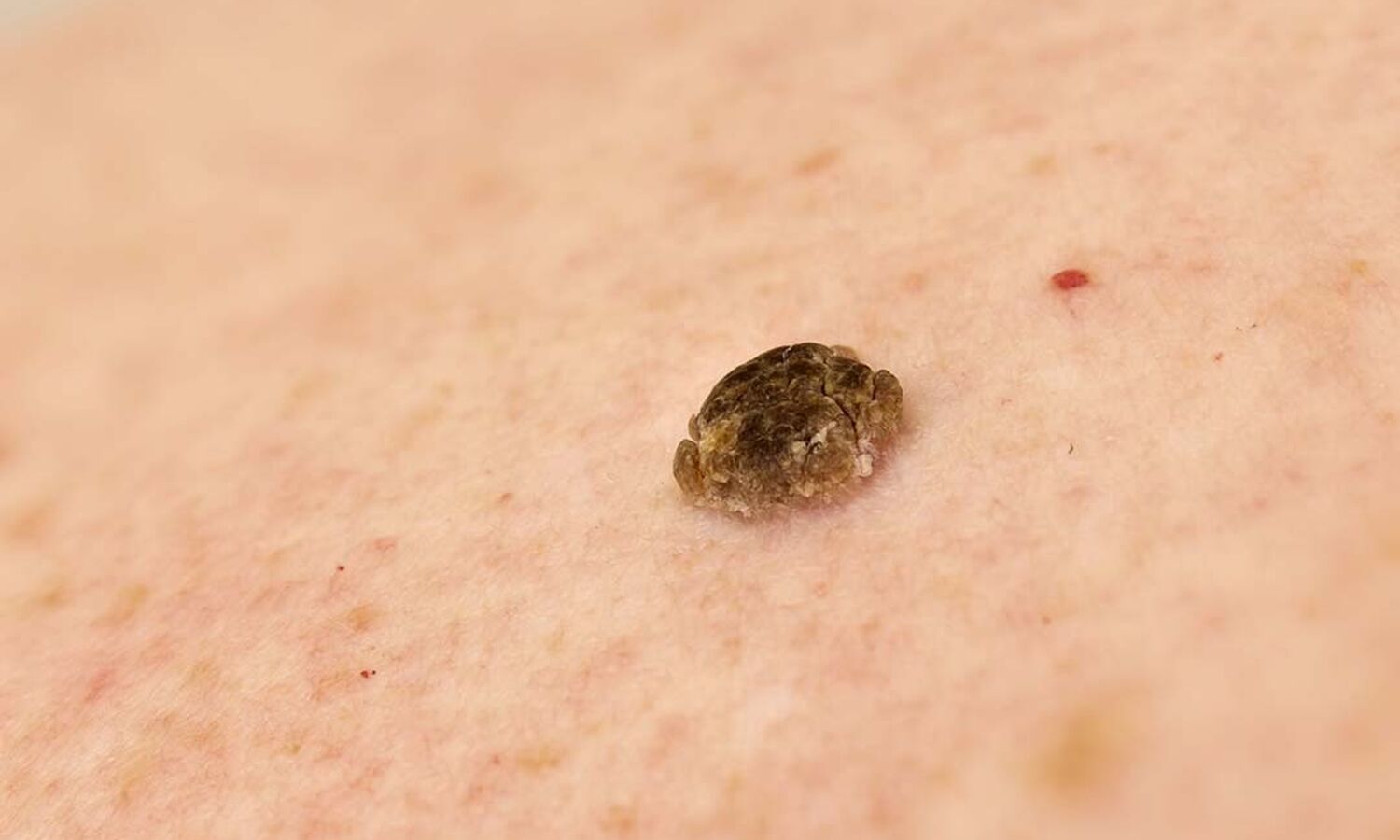 Huidtherapeut Groenlo Huidprobleem ouderdomswrat