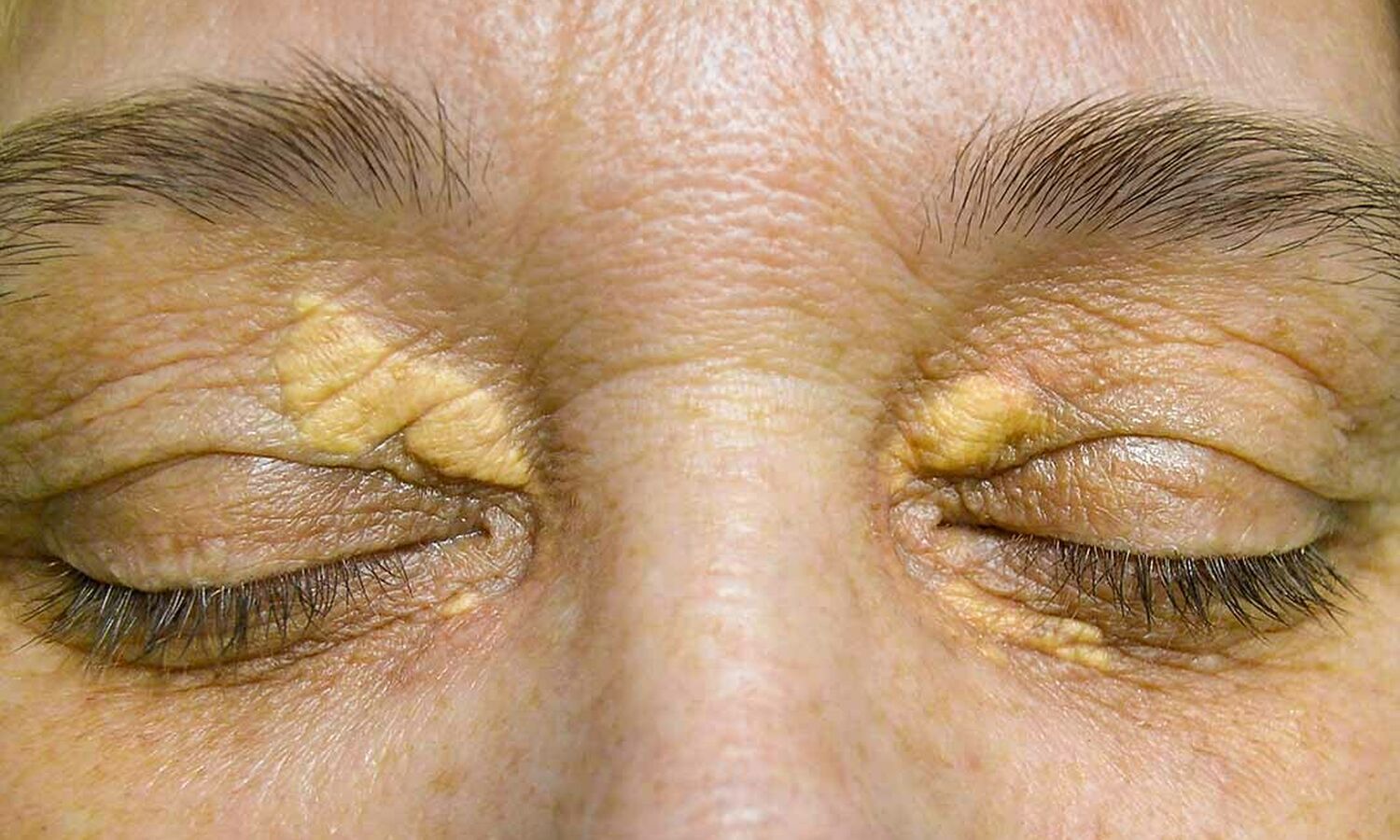 Huidtherapeut Groenlo Huidprobleem Xanthelasma