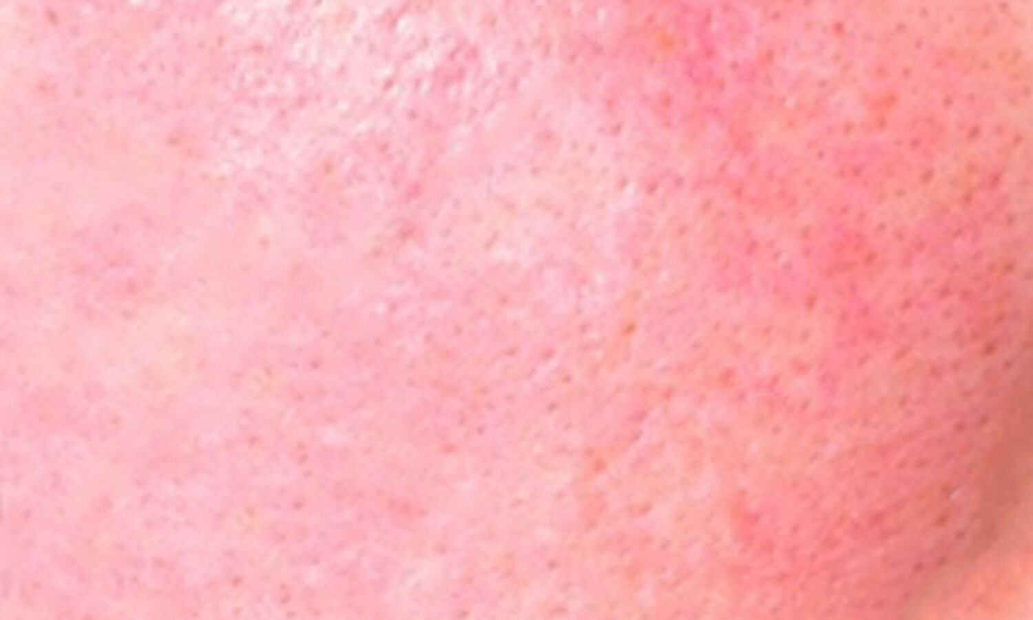 Huidtherapeut Groenlo Huidprobleem Diffuse roodheid