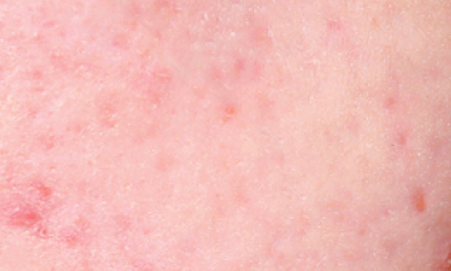 Huidtherapeut Groenlo Huidprobleem PIE