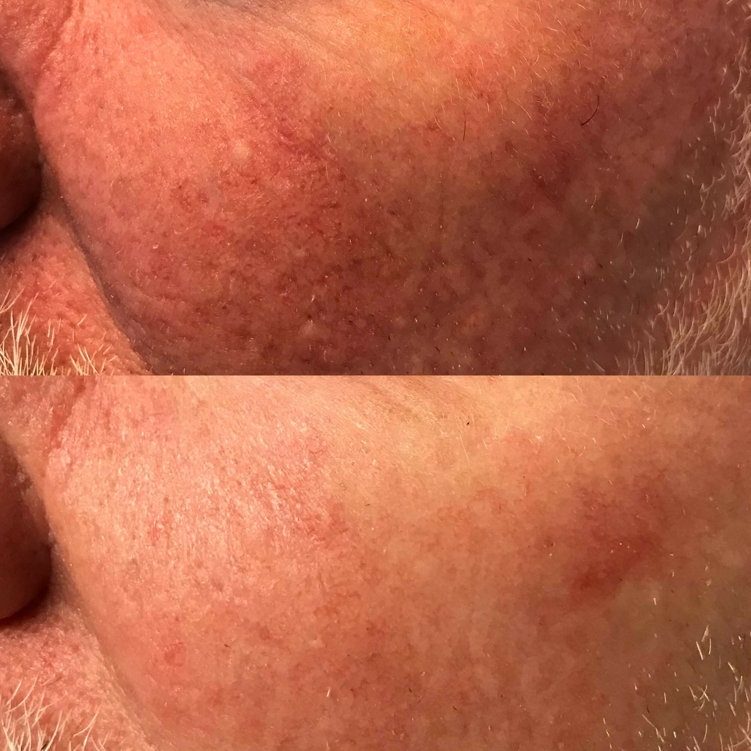 Rosacea behandeling huidtherapeut Groenlo