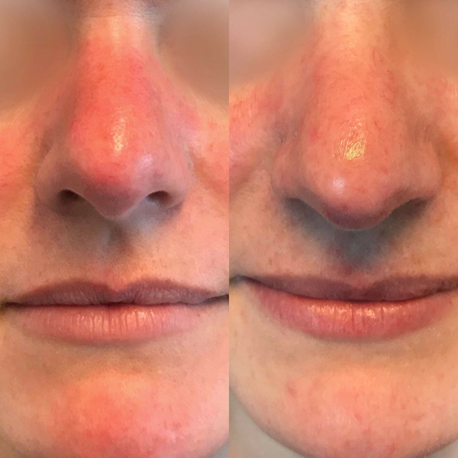 Roodheid behandeling YESS Huidtherapie huidtherapeut Groenlo