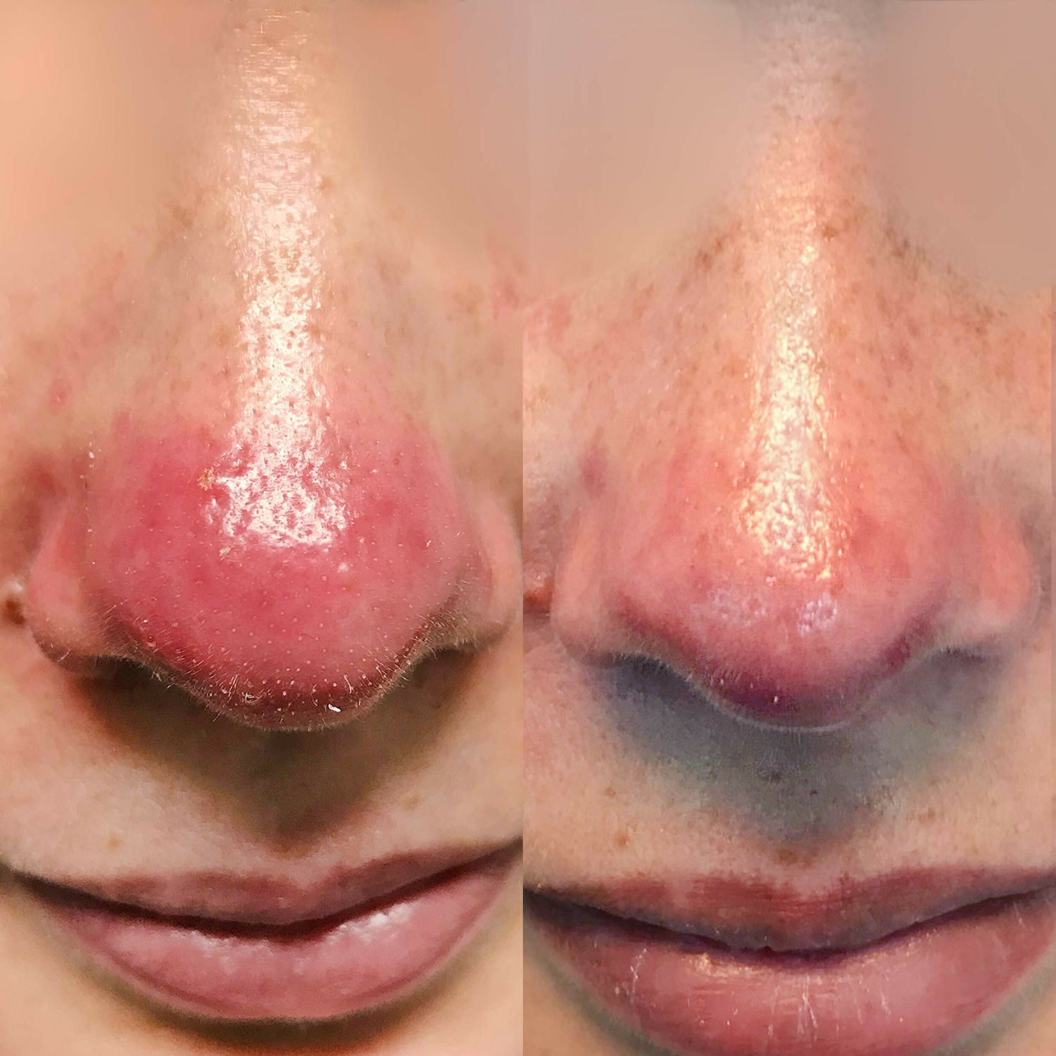 Roodheid behandeling huidtherapeut Groenlo