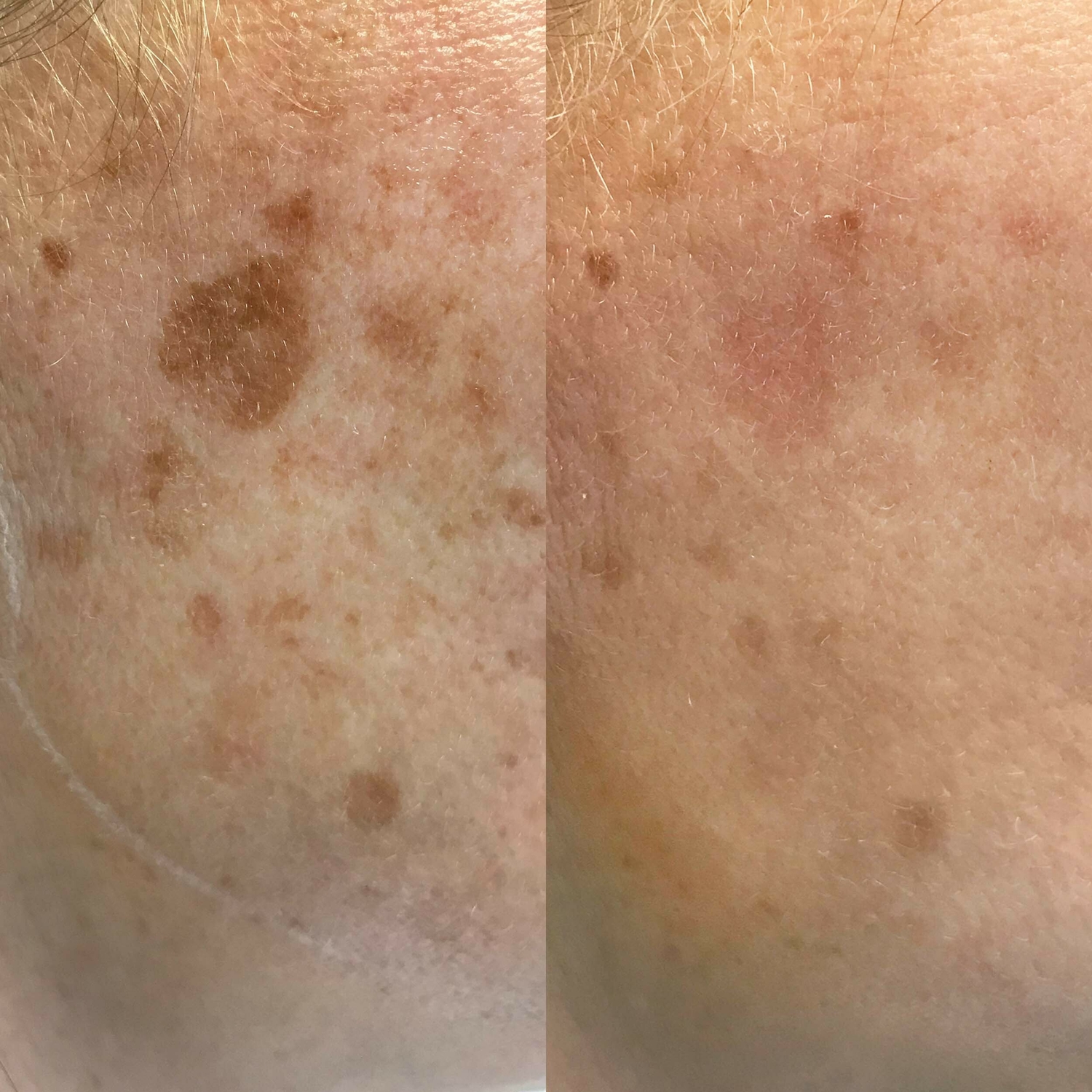 Pigment IPL behandeling huidtherapeut Groenlo