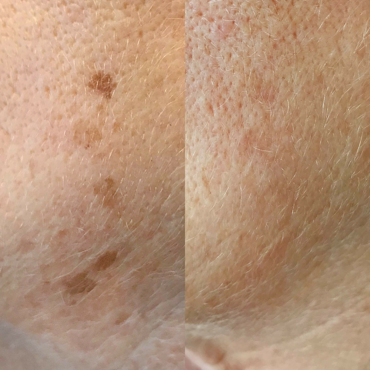 Pigment IPL behandeling Groenlo