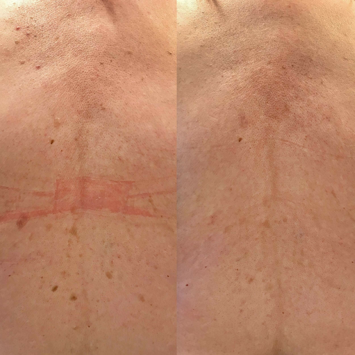 Ouderdomswratten behandelen Huidtherapeut Groenlo