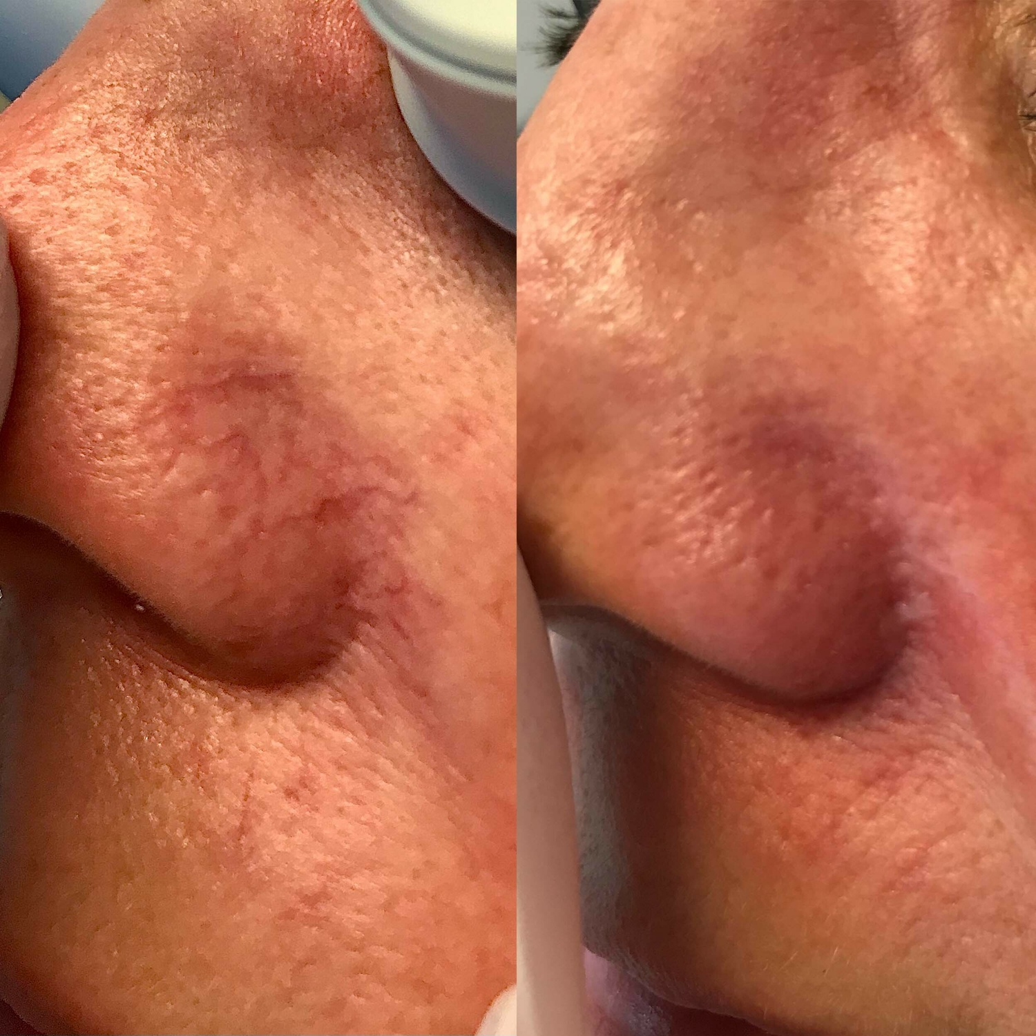 IPL Behandeling Bloedvaatjes Huidtherapie Groenlo