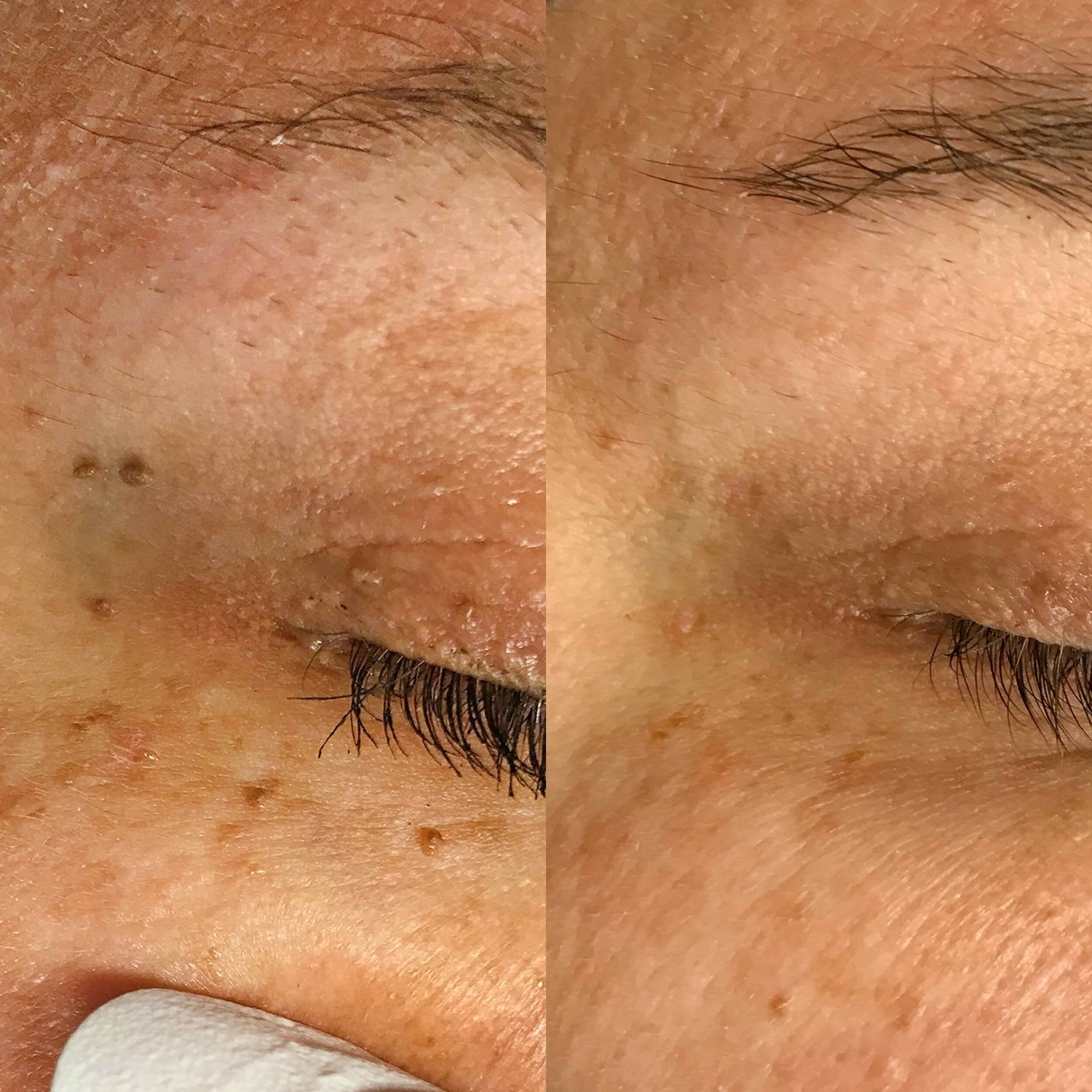 Huidoneffenheden verwijderen huidtherapeut Groenlo