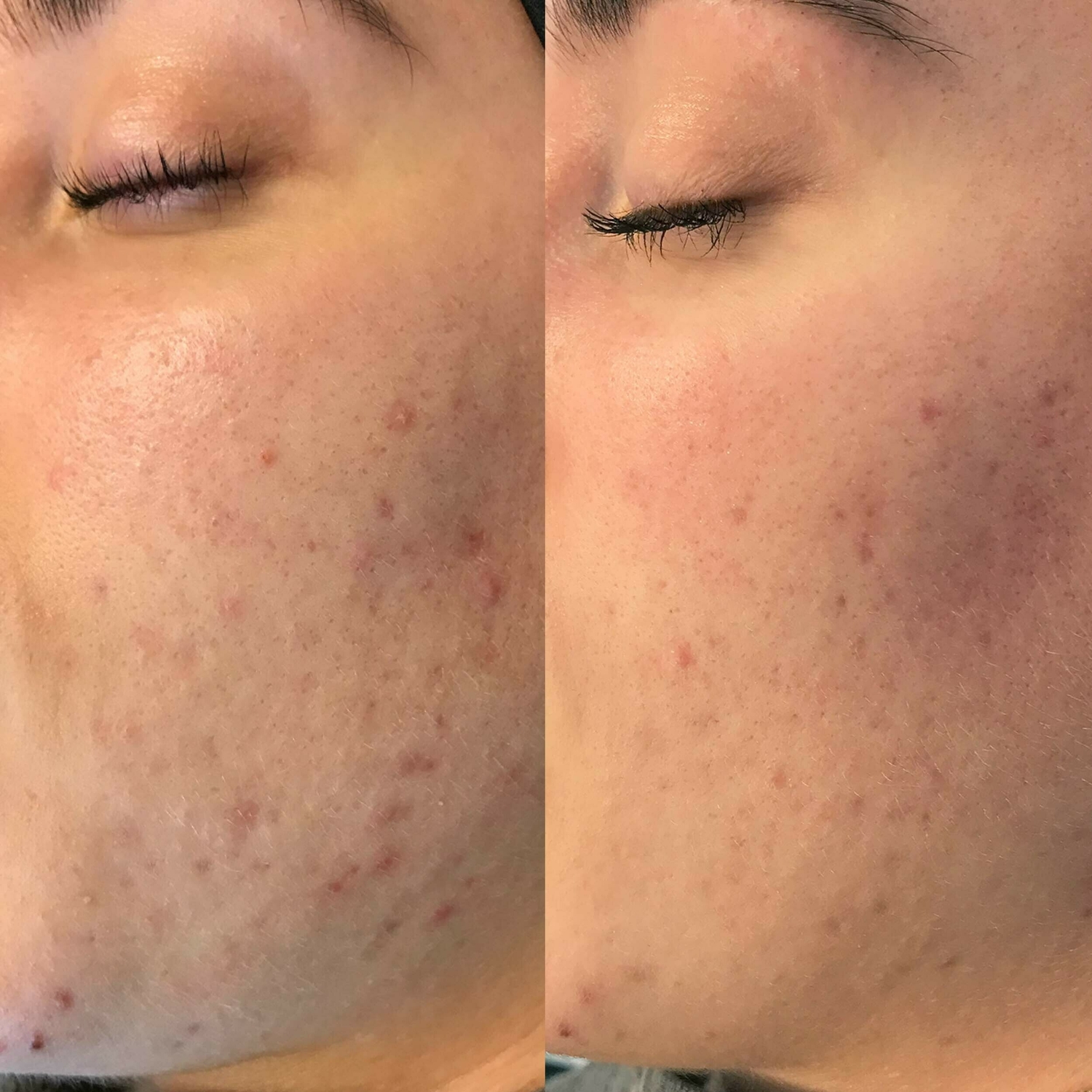 Acne behandeling Huidtherapeut Groenlo