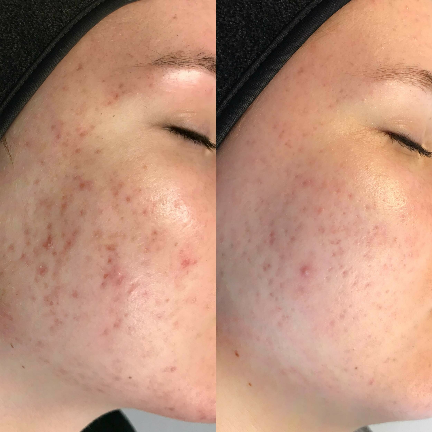 Acne behandelen Huidtherapeut Groenlo