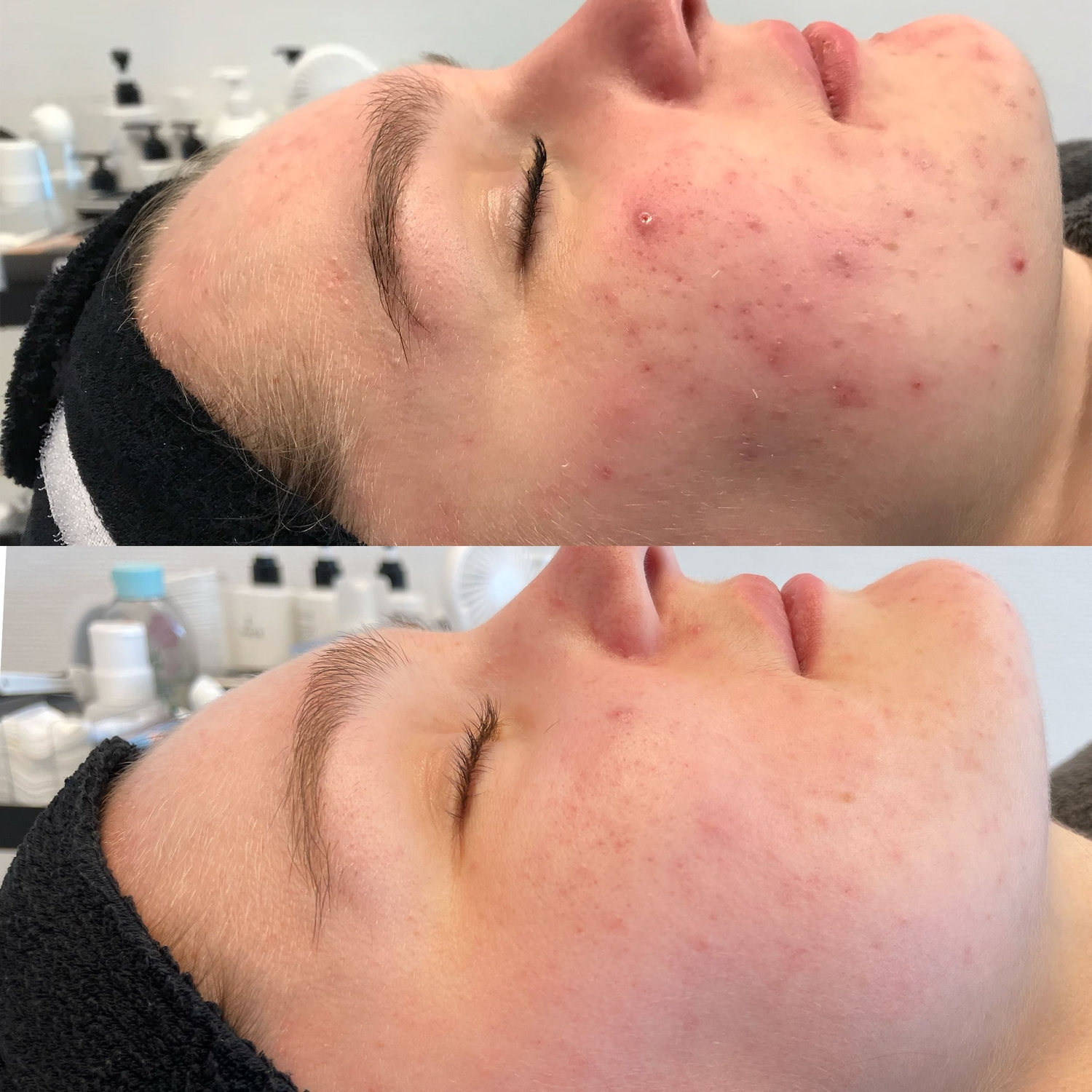 Acne behandeling huidtherapie groenlo