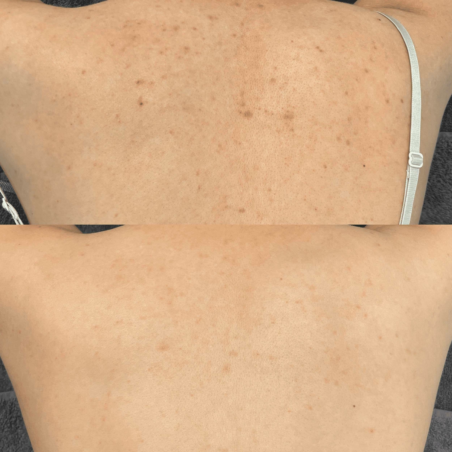 Acne rug verminderen groenlo