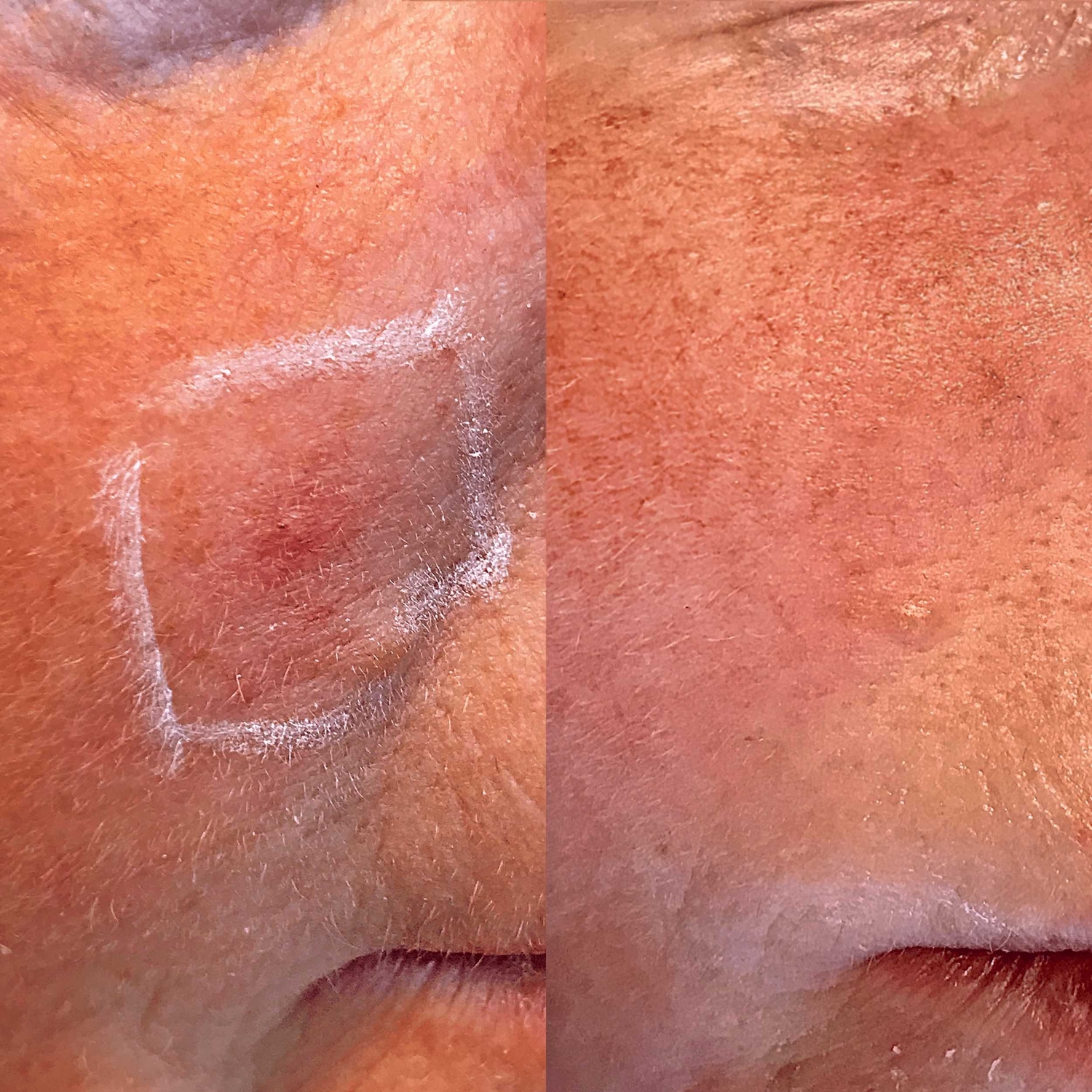 Bloedvaatje verwijderen huidtherapie groenlo