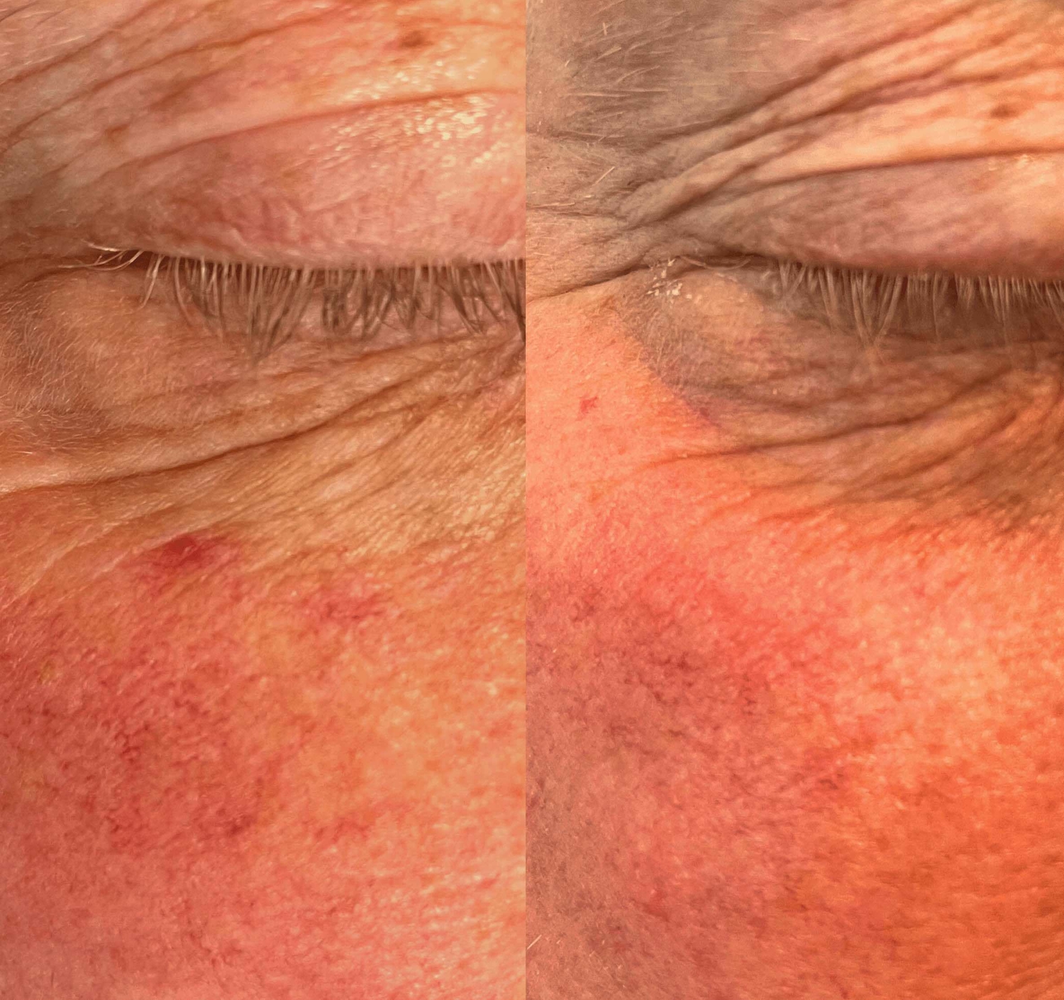 Bloedvaatjes IPL behandeling huidtherapeut groenlo