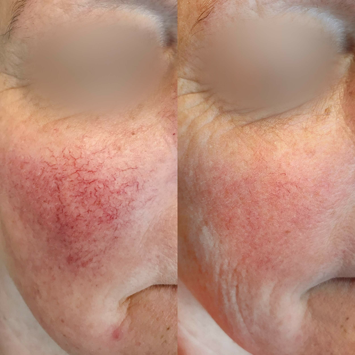 Couperose behandelen huidtherapie groenlo