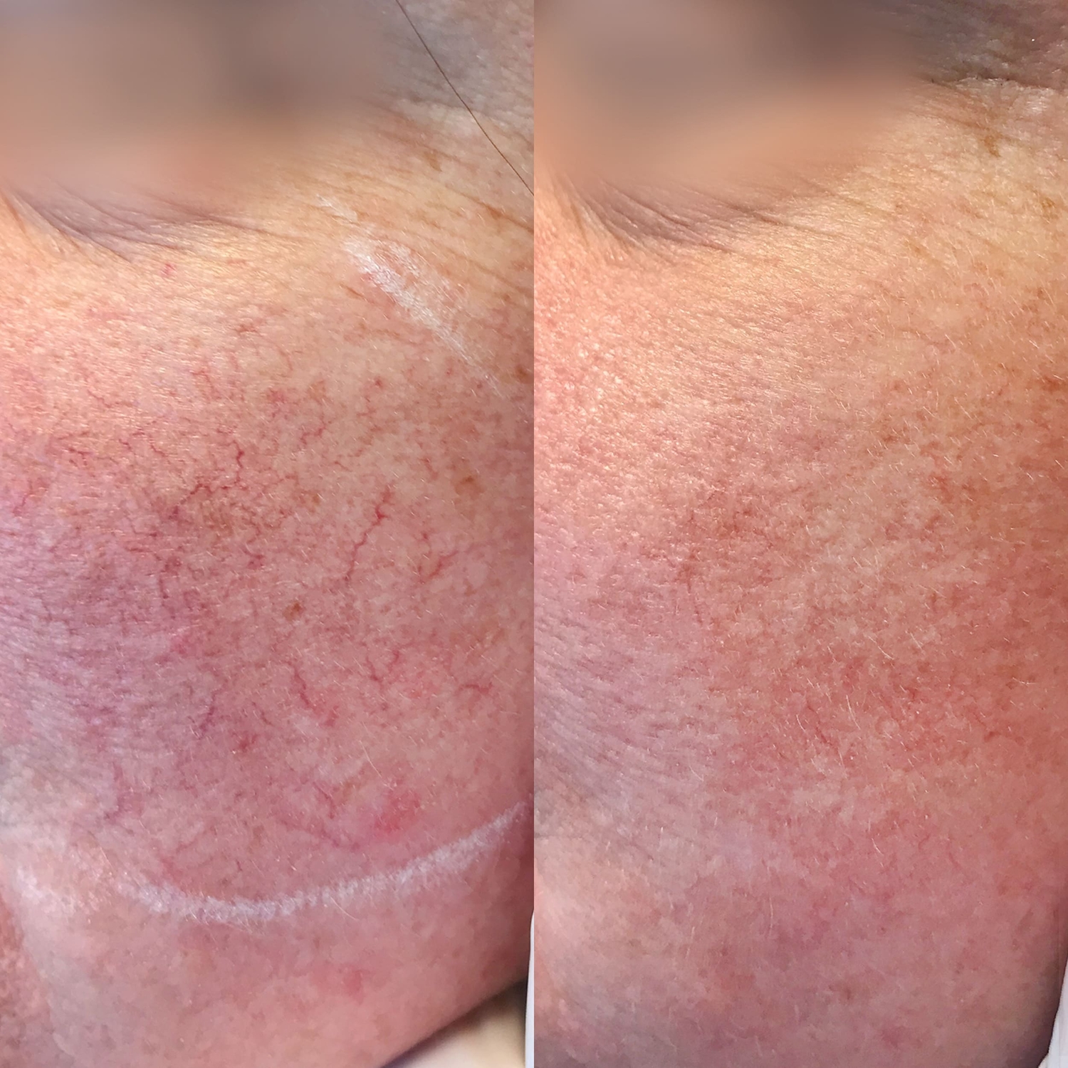 Couperose behandeling huidtherapeut Groenlo