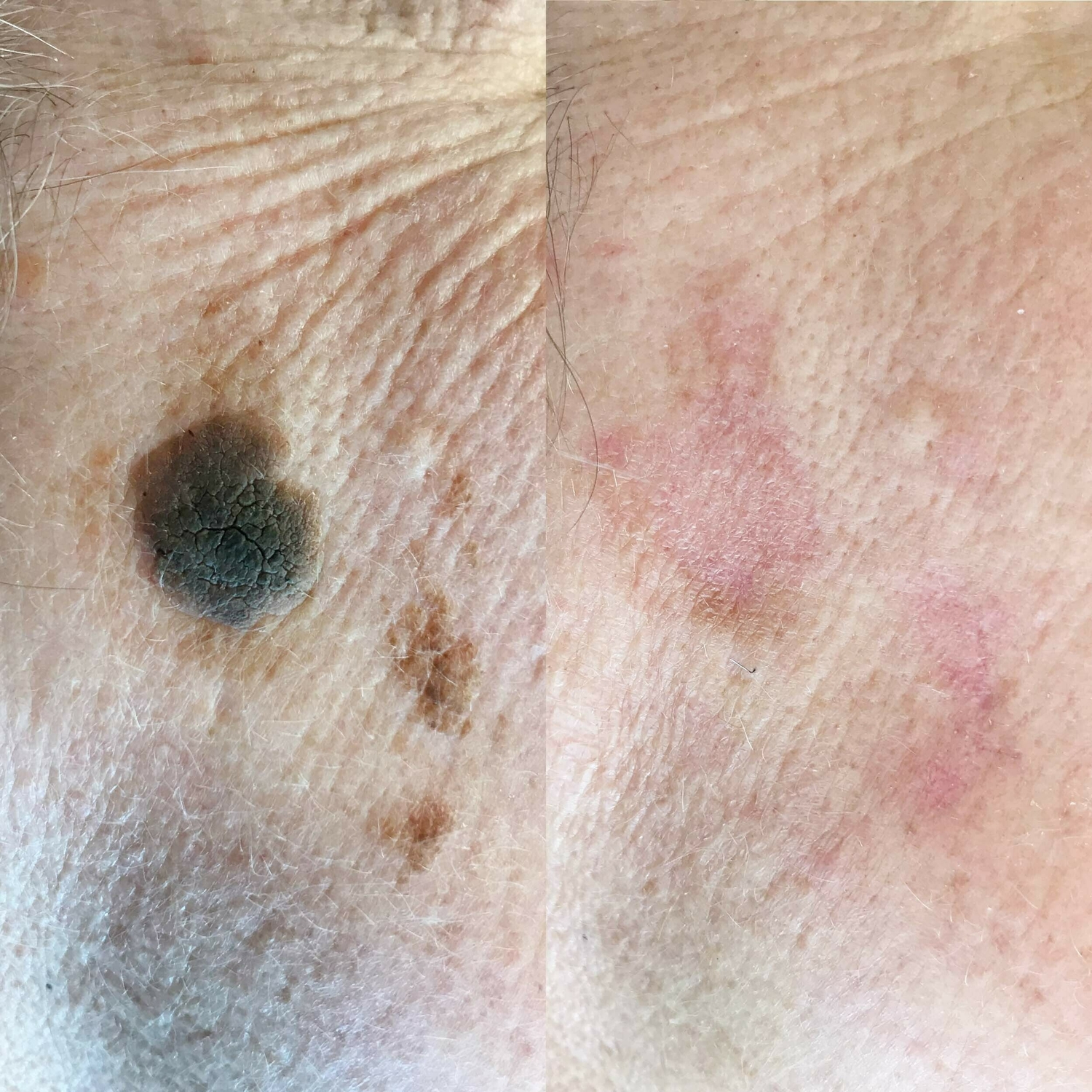 Huidoneffenheden behandeling huidtherapie groenlo