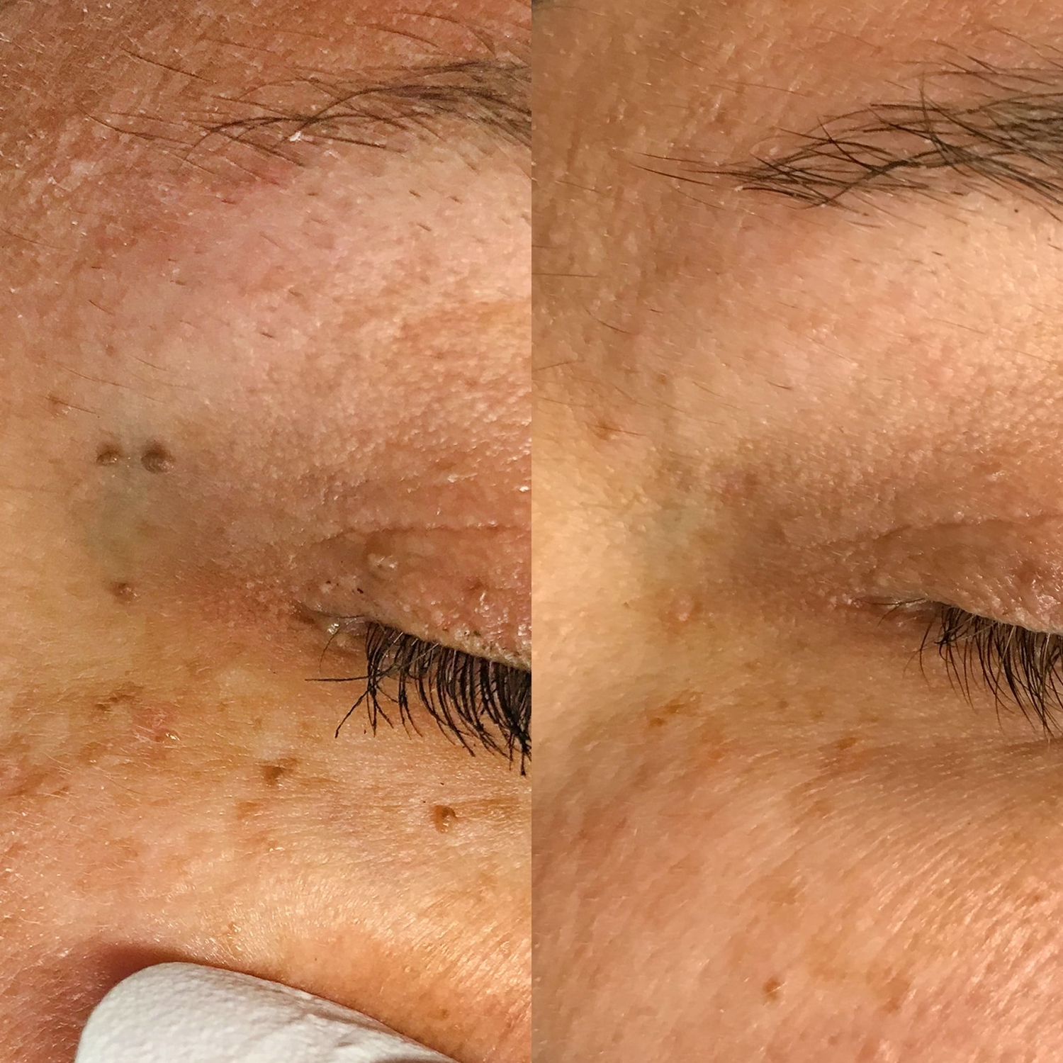 Huidoneffenheden verwijderen huidtherapie groenlo