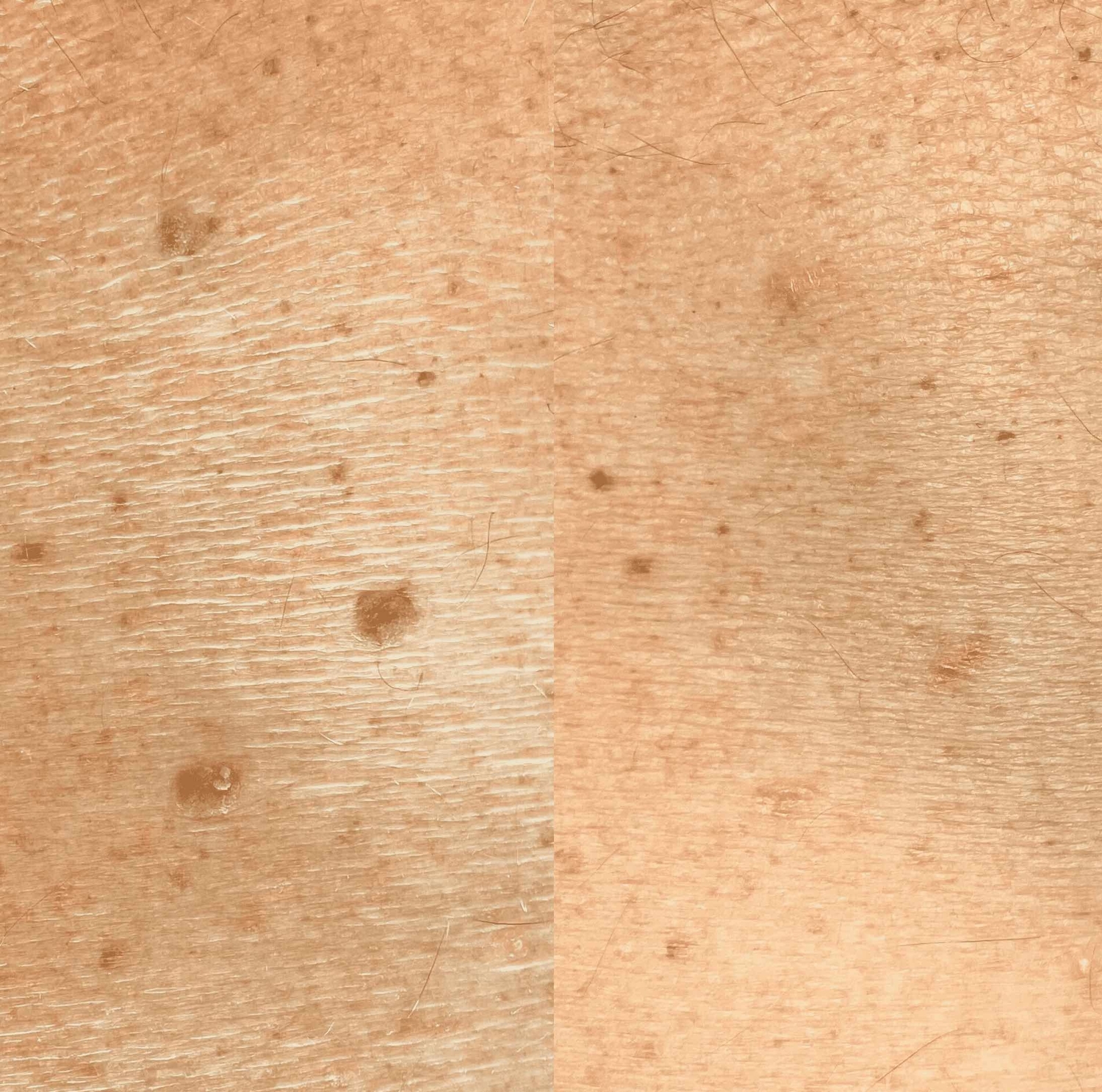 Ouderdomsvlekken verwijderen huidtherapie groenlo