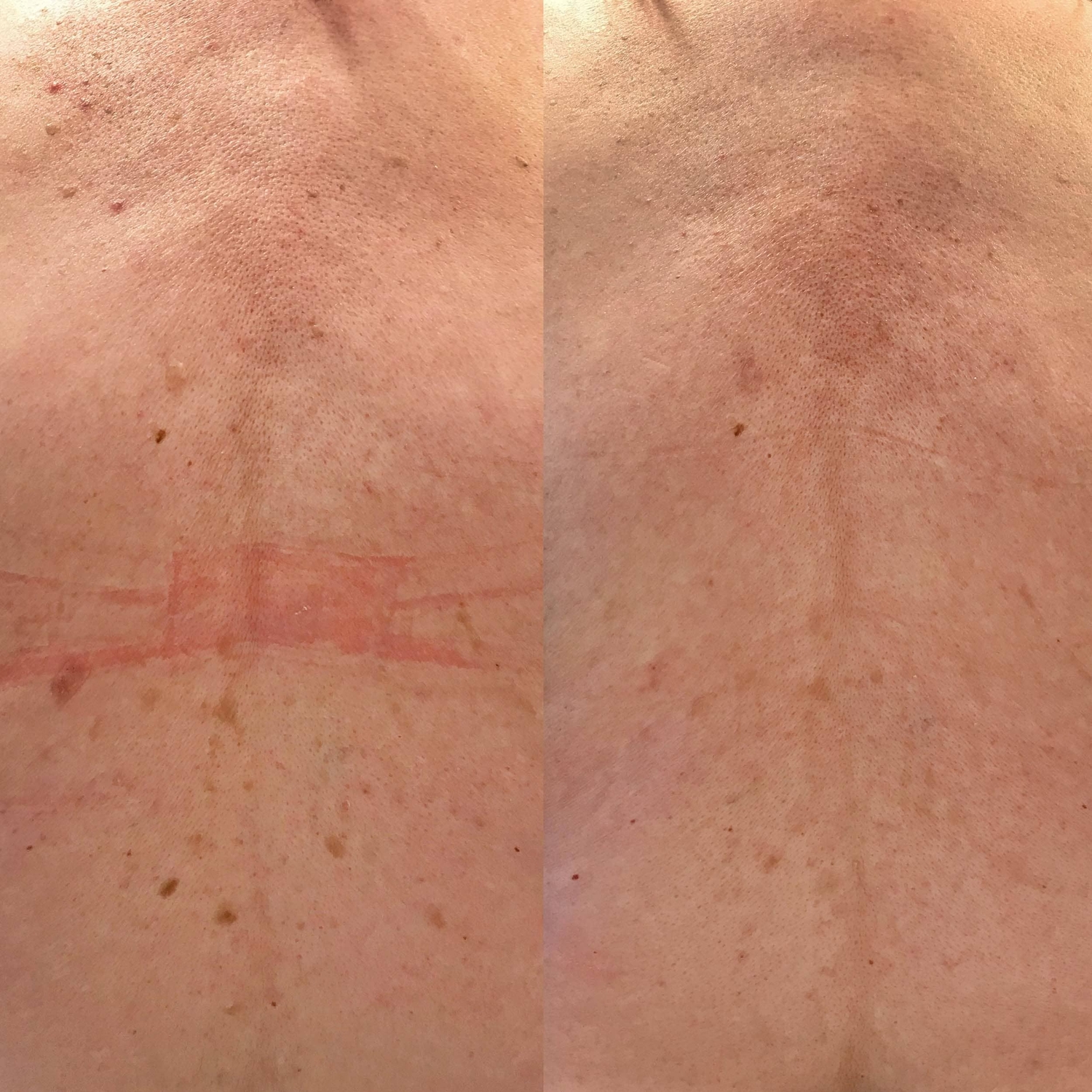 Ouderdomswratten behandelen huidtherapeut groenlo