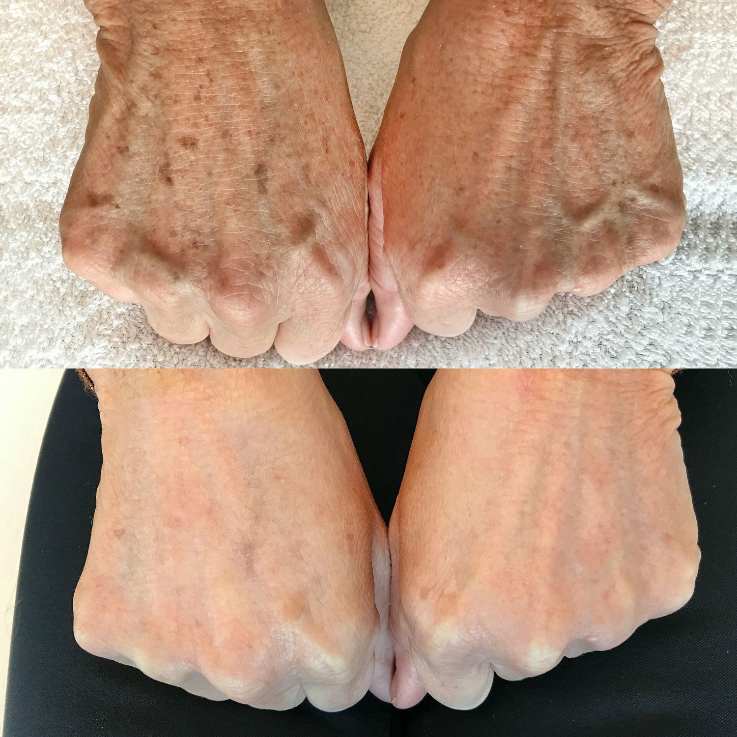 Pigmentvlekken behandelen huidtherapie groenlo