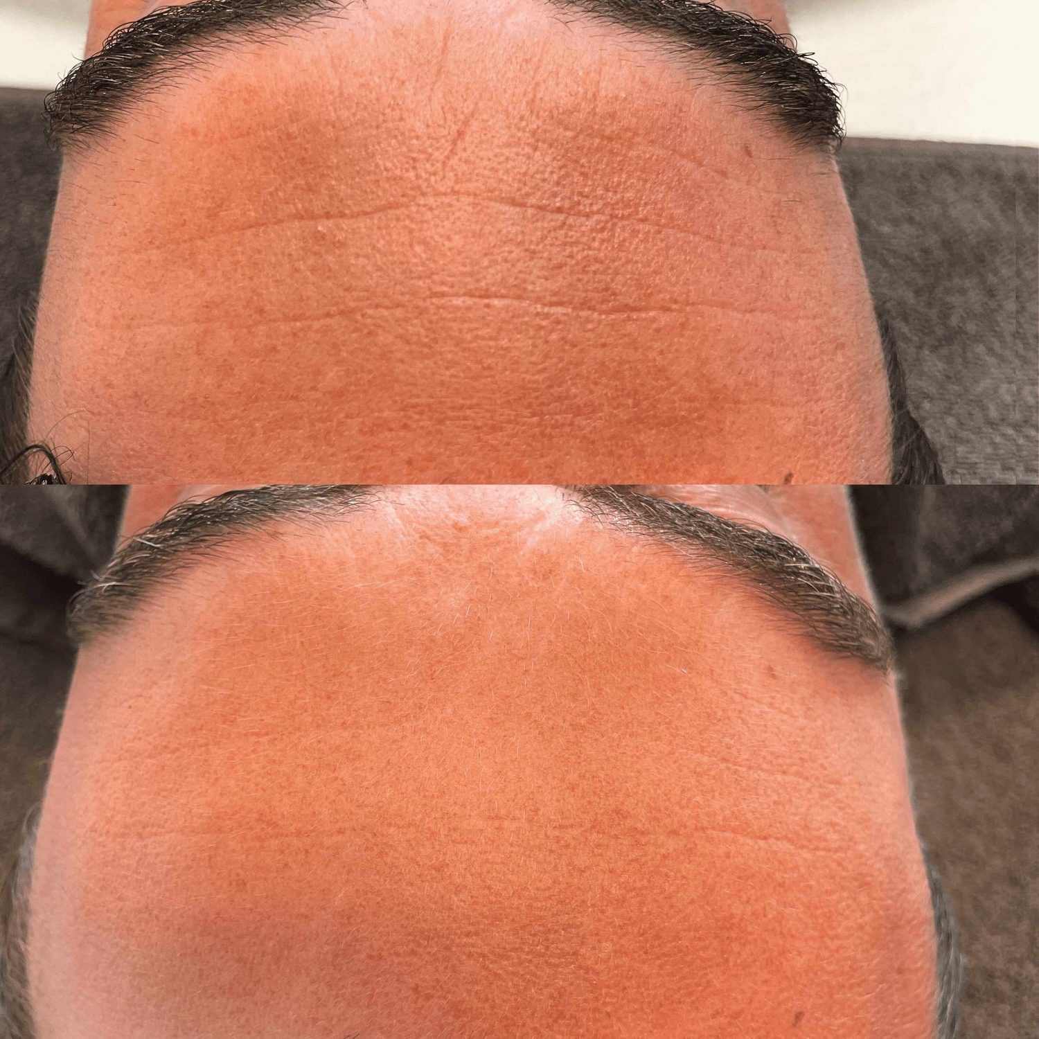 Rimpels verminderen huidtherapie groenlo