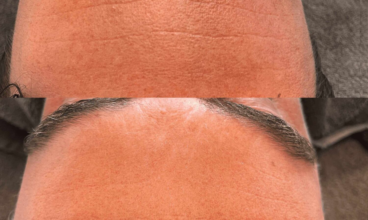 Rimpels verminderen huidtherapie groenlo