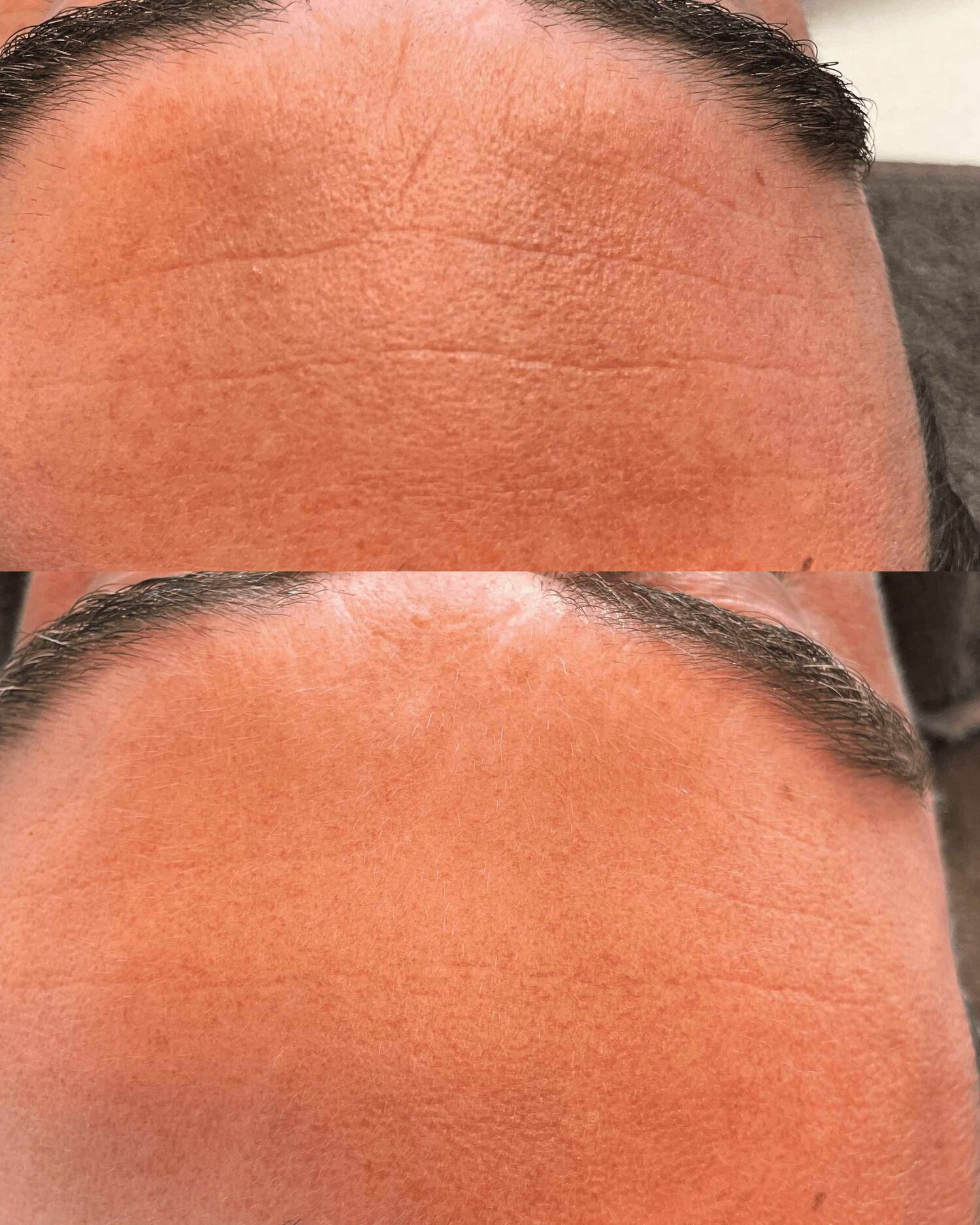 Rimpels verminderen huidtherapie groenlo