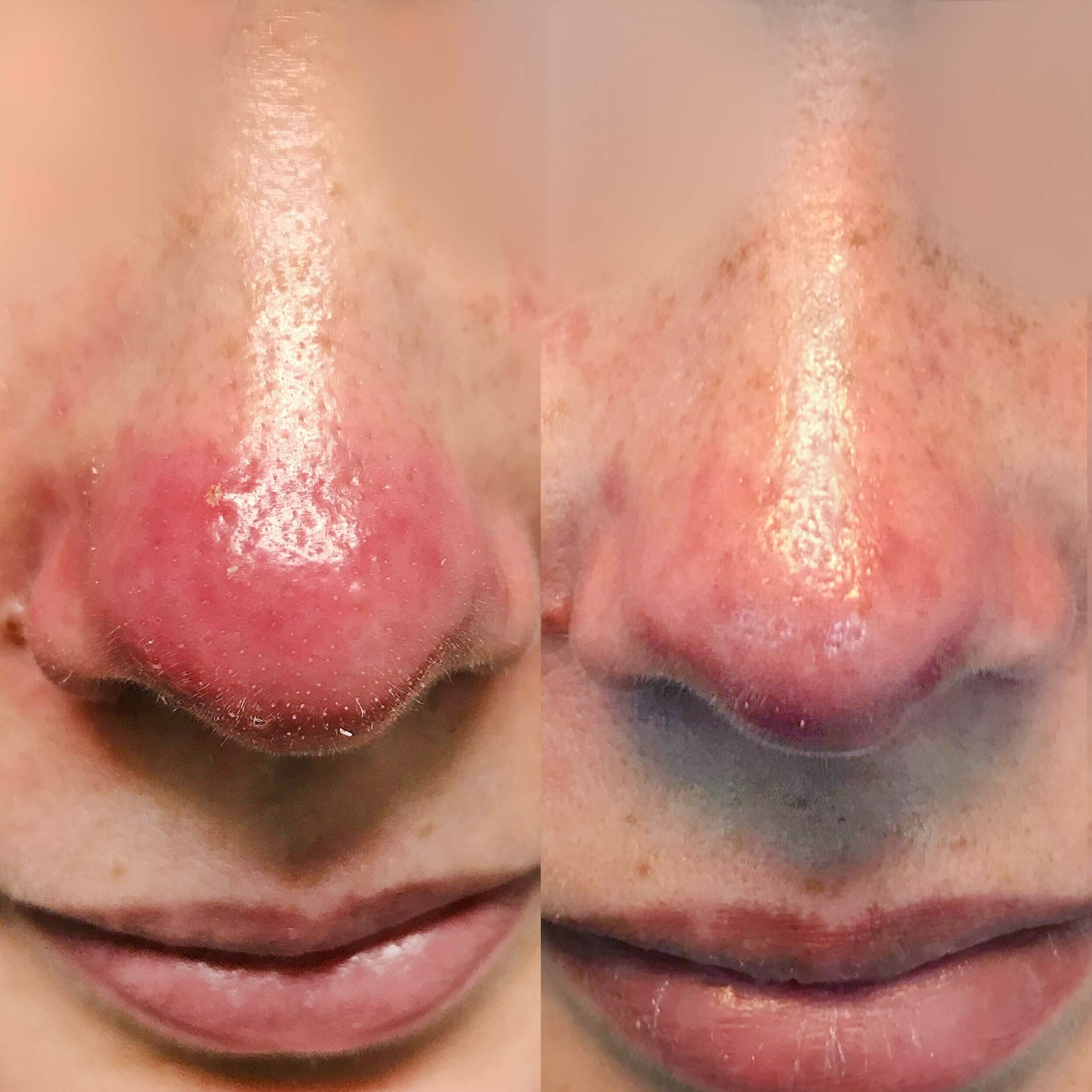 Rode huid verminderen groenlo