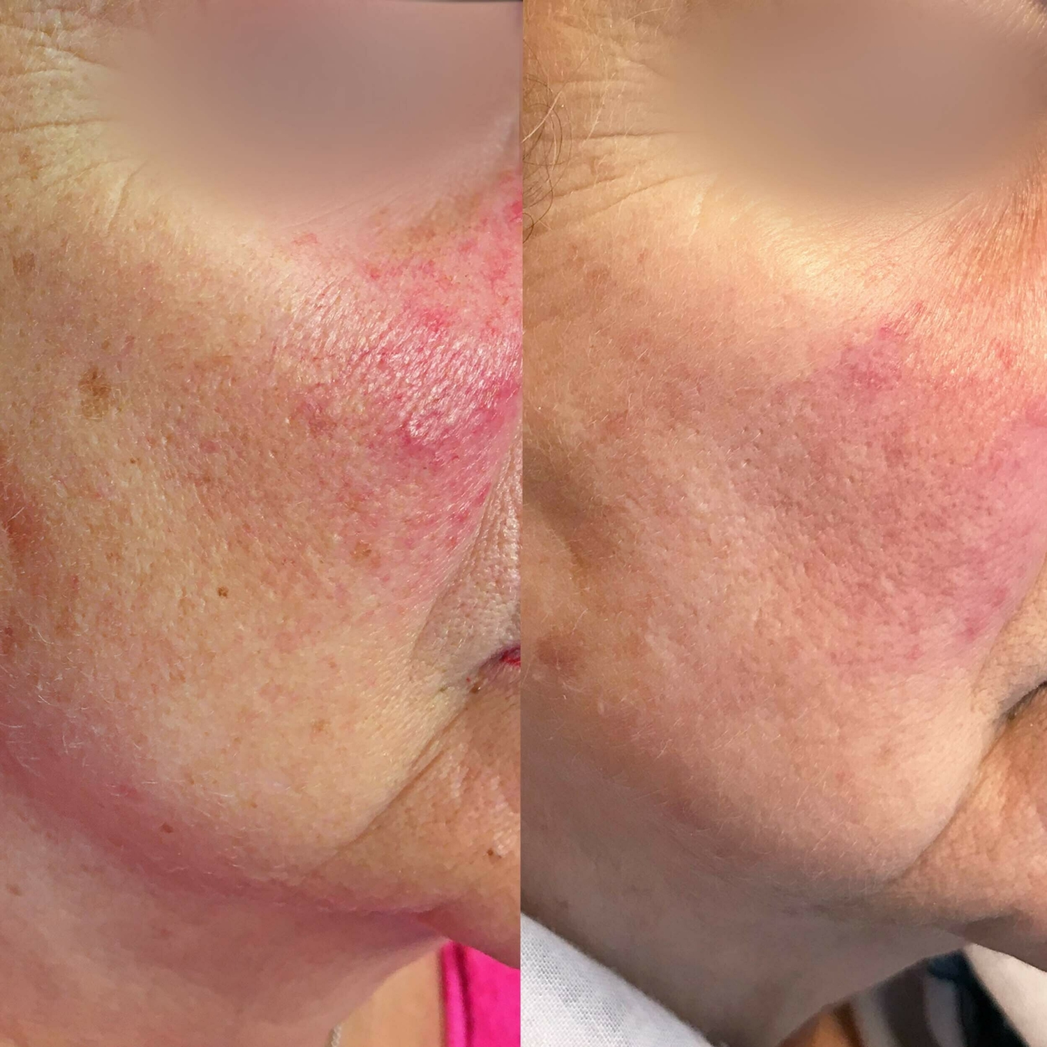 Rode wangen behandelen groenlo