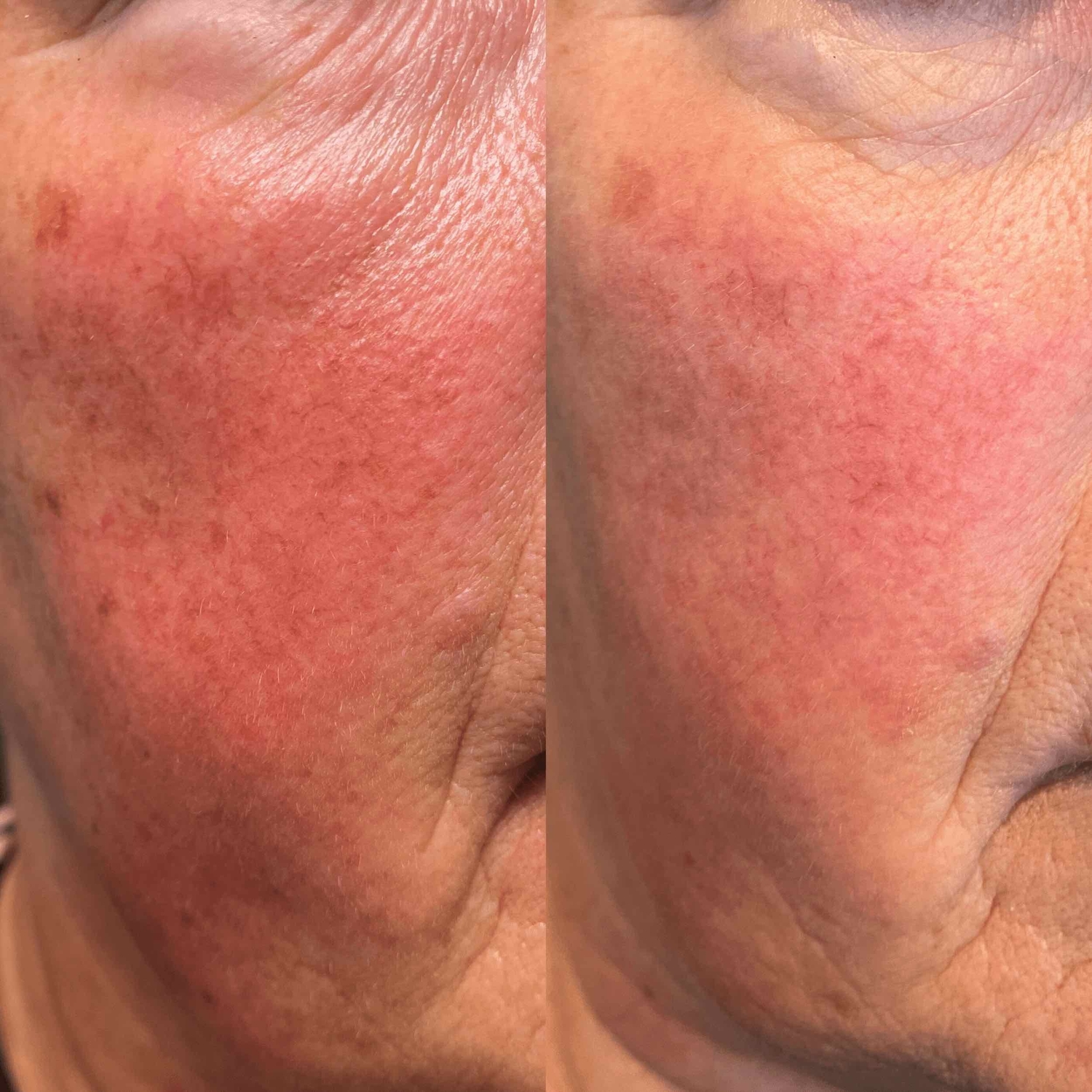 Roodheid behandelen Groenlo