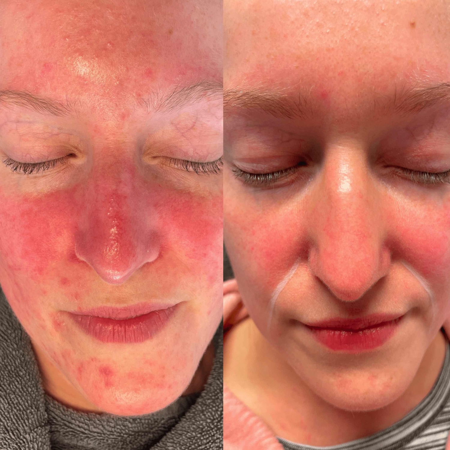 Roodheid behandeling huidtherapeut groenlo