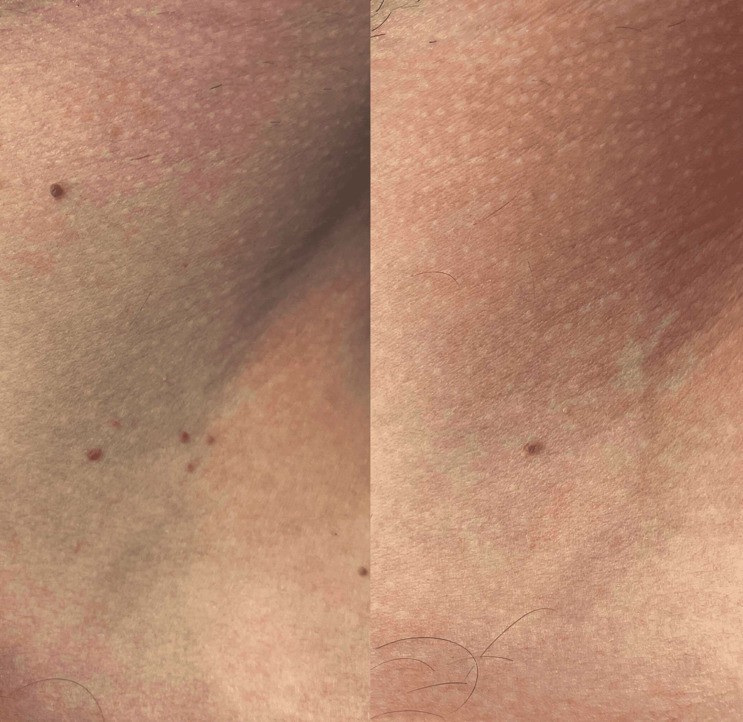 Steelwratjes verwijderen groenlo