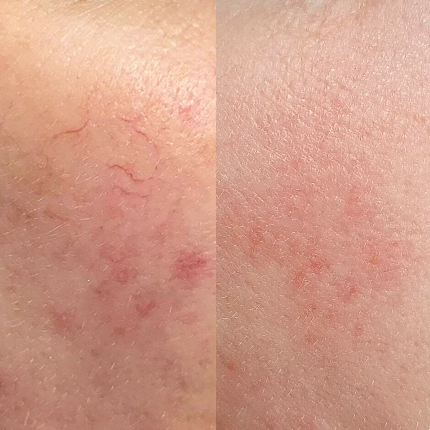 Vaatjes gezicht verminderen groenlo